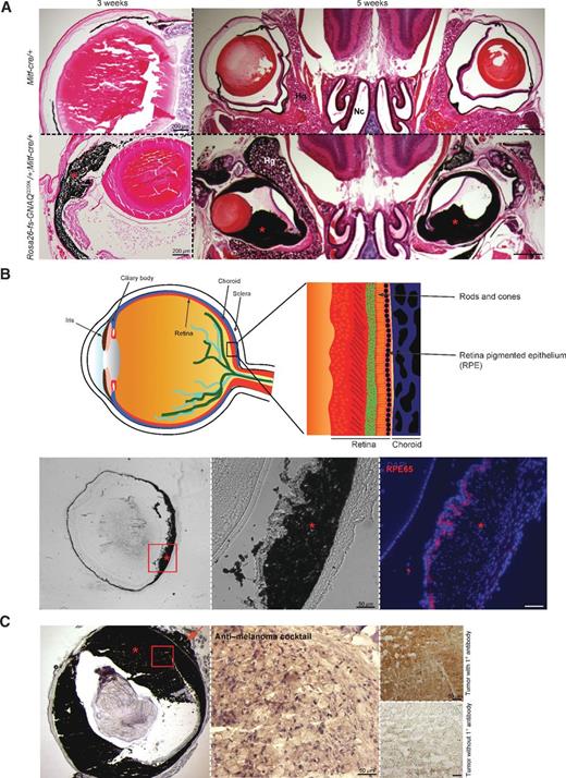 Figure 4. Uveal melanoma in Rosa26-floxed stop-GNAQQ209L/+; Mitf-cre/+ mice. A, progression of uveal melanoma in 3-week-old (left bottom) and 5-week-old (right bottom) Rosa26-floxed stop-GNAQQ209L/+; Mitf-cre/+ mice. B, structures of the eye (top). Anti-RPE (red) stains a single layer of retinal pigmented epithelial cells above the developing melanoma in a 3-week-old Rosa26-floxed stop-GNAQQ209L/+; Mitf-cre/+ mouse (right subpanel; bottom). Corresponding light microscopy images (left and middle). Red box, area of enlargement. C, a uveal melanoma from a 5-month-old mouse stains positive for the antimelanoma antibody cocktail (DAB, brown; top right). Melanoma before bleaching (left) and counterstained with hematoxylin (middle). Red arrow, extraocular extension of the melanoma. Hg, harderian gland; Nc, nasal cavity; red asterisks, uveal melanomas.