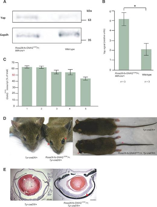 Figure 5. Yap activation and enhanced GNAQQ209L allele expression in uveal melanomas. A, representative Western blot analysis against Yap and Gapdh using nuclear protein extracted from Rosa26-floxed stop-GNAQQ209L/+; Mitf-cre/+ and +/+; +/+ or Rosa26-floxed stop-GNAQQ209L/+; +/+ eyes (“wild-type”). B, increased nuclear Yap is detected in Rosa26-floxed stop-GNAQQ209L/+; Mitf-cre/+ eyes (P = 0.02, Welch two-sample t test). Signal was normalized to Gapdh and a wild-type sample included in each experiment. C, four of five human uveal melanoma samples contain more GNAQQ209L transcript than wild-type transcript, measured by pyrosequencing. Signal is corrected for the amount of each allele in the DNA of each sample. D, bilateral eye bulging (red arrowheads, left) and skin hyperpigmentation (red arrowheads, right) in a 4-month-old tamoxifen-treated Rosa26-floxed stop“fs”-GNAQQ209L/+; Tyr-creER/+ mouse, compared with treated control littermate. E, melanocytic hyperplasia (red arrowhead), but not uveal melanoma, in the eye of the same mouse.