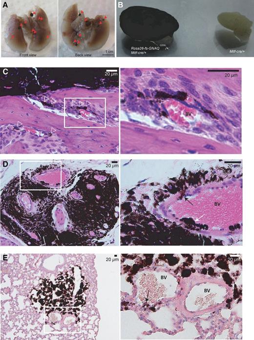 Figure 7. Melanocytic lesions in the lungs and blood vessel intravasation. A, multiple pigmented lesions in the lungs of a 3-month-old Rosa26-floxed stop-GNAQQ209L/+; Mitf-cre/+ mouse (red arrowheads). Front and back of lungs are shown. B, enlarged and darkly pigmented lymph nodes from a 3-month-old Rosa26-floxed stop“fs”-GNAQQ209L/+; Mitf-cre/+ mouse (left). C and D, tracks of pigmented cells extending from eye lesion toward blood vessels (open arrowheads in C), invading vessel walls (black arrow in D), or growing within the lumen (white arrow in D) in 3-month-old Rosa26-floxed stop“fs”-GNAQQ209L/+; Mitf-cre/+ mice (hematoxylin and eosin). Enlarged areas on the right are indicated by white boxes on left. E, lung lesion closely associated with blood vessels showing signs of intravasation (black arrow) in a 3-month-old Rosa26-floxed stop“fs”-GNAQQ209L/+; Mitf-cre/+ mouse (hematoxylin and eosin). BV, blood vessel.