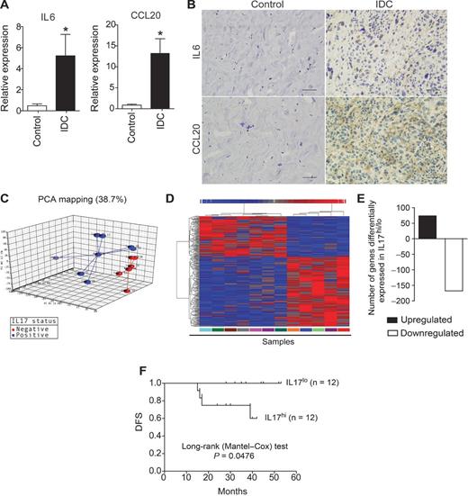 Figure 7. Expression of Th17-promoting cytokines in the tumor microenvironment of patients with IDC. RNA from breast tumor and healthy control tissue was extracted and analyzed by qPCR. A, the relative expression levels of IL6 and CCL20 are shown. Data are reported as the mean ± SEM of patients (N = 23) or healthy control subjects (N = 8) who were tested individually. The control values were significantly different compared with those of patients with IDC (*, P < 0.05; t test). B, immunohistochemical staining of healthy control (left) and breast tumor tissue (right) was used to detect IL6 and CCL20 protein; scale bars, 50 μm. RNA from breast tumor tissue was extracted, and the gene-expression profiles of samples with low and high IL17A expression were analyzed by microarray. C, principal component analysis of gene-expression microarray 3D scatter plot showing the first three principal components; each patient sample is connected to a centroid for each group (IL17-positive and IL17-negative). D, heat map showing the hierarchical clustering of the gene-expression profiles of samples with low and high IL17A expression as analyzed by microarray. Values are expressed as the relative units of induction (positive values in red), repression (negative values in blue), and no modulation (gray). E, the bar graph shows the number of genes that were down- and upregulated. F, Kaplan–Meier curves illustrate the DFS of patients according to the expression of IL17A. Log-rank P values for the DFS of patients with low and high gene expression were calculated. The data represent the mean ± SEM of 23 patients with IDC (*, P < 0.05).