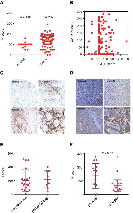 Figure 5. Analysis of POR expression by IHC and hypoxia in HNSCC. A, comparison of POR H scores in lingual SCC cores and adjacent nonmalignant epithelia. B, coexpression of POR and the endogenous hypoxia marker CA-IX in lingual SCC cores. C, micrographs (×20 objective lens) showing CA-IX staining in representative lingual SCC cases from cohort 1. D, micrographs (×10 objective lens) showing POR staining in representative HNSCC cases from cohort 3. E, POR H scores according to tumor [18F]-MISO PET status. F, HPV/p16 status in cohort 3. Statistical significance of differences in staining intensity between p16-positive/negative tumors was evaluated using unpaired t-tests.
