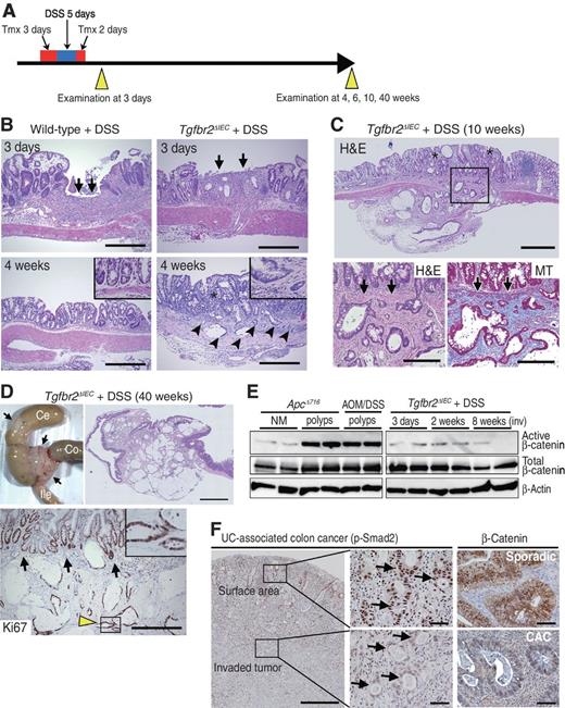 Figure 2. Submucosal invasion of TGFβ signaling-suppressed cells by ulcerative colitis. A, schedule for tamoxifen and DSS treatment and examination of mice. B, representative photographs (H&E) of DSS-treated wild-type (left) and DSS-treated Tgfbr2ΔIEC (right) mouse colons 3 days (top) and 4 weeks (down) after treatment. Arrows (top), ulcer lesions. Arrowheads (bottom right), submucosal invasion of epithelial cells. *, impaired regeneration of the normal gland structure. Bars, 200 μm. C, representative photographs of invasive tumors of a DSS-treated Tgfbr2ΔIEC mouse 10 weeks after treatment. H&E (top), enlarged images of the boxed areas (bottom left), and Masson trichrome (MT) staining of serial section (bottom right). Arrows, location of muscularis mucosae. *, impaired regeneration of the normal gland structure. Bars, 500 μm (top and middle) and 200 μm (bottom). D, representative macroscopic photographs of invasive tumors developed in a DSS-treated Tgfbr2ΔIEC mouse at 40 weeks after treatment (arrows, top left), and the H&E (top right) and immunohistochemistry for Ki67 (bottom). Arrows (bottom), the location of muscularis mucosae; and inset, enlarged image of the boxed area. Ce, cecum; Ile, ileum; Co, colon. Bars, 2 mm (top) and 400 μm (bottom). E, immunoblotting for active β-catenin and total β-catenin in the intestinal mucosa and polyps in ApcΔ716 and AOM/DSS-treated mice (left) and DSS-treated Tgfbr2ΔIEC mice (right) at the indicated time points. NM, normal mucosa; and inv, invasive tumors. β-Actin was used as an internal control. F, representative immunohistochemical findings of p-Smad2 in ulcerative colitis–associated human colon cancer tissues (left, center), and the β-catenin in sporadic colon cancer (top right) and ulcerative colitis–associated colon cancer (UC; right bottom). Arrows (center), surface epithelial cells and invading tumor cells. Bars, 500 μm (left) and 50 μm (center and right).