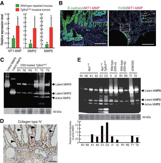 Figure 4. Expression of MT1-MMP and activation of MMP2 in invasive tumors. A, expression levels of indicated MMPs in the DSS-treated Tgfbr2ΔIEC mouse invasive tumors (red) relative to the level of repaired mucosa of DSS-treated wild-type mice (green; mean ± SD). *, P < 0.05 versus wild-type level. B, fluorescent immunostaining of the invasive tumors in DSS-treated Tgfbr2ΔIEC mice for E-cadherin (green), MT1-MMP (red; left), F4/80 (green), and MT1-MMP (red; right). Insets, enlarged images of the boxed areas. Bars, 200 μm. C, gelatin zymography of the normal mucosa (N1-N3) and invasive tumors (T1-T3) of three individual DSS-treated Tgfbr2ΔIEC mice. Latent MMP9 and MMP2 were used as positive controls. D, immunostaining for collagen type IV in the invasive colon tumors of DSS-treated Tgfbr2ΔIEC mice. White arrowheads, invading epithelial cells in submucosa; closed arrowheads, noninvading epithelial cells. Bars, 50 μm. E, gelatin zymography of the normal intestinal mucosa (N1-N2) and intestinal adenomas (A1-A2) of ApcΔ716 mice, invasive adenocarcinomas (C1-C2) of ApcΔ716 Tgfbr2ΔIEC mice, ulcerative colitis tissues of DSS-treated wild-type mice (I1-I2), repaired mucosa of DSS-treated wild-type mice (R1-R2), and noninvasive colon tumors (T1-T2) of azoxymethane/DSS-treated wild-type mice. Coomassie Brilliant Blue staining of the 40-kDa bands is shown at the bottom of the zymography gels as a protein level control (C and E). Relative band intensities for active MMP2 to the mean level of ApcΔ716 adenomas (red bar) are shown in a bar graph (E, bottom).