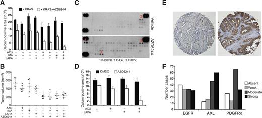 Figure 5. A, viability (calcein staining) of iKRAS cells with continuous KRASG12D expression (cultured in the presence of doxycycline) cultured for 7 days in the presence or absence of 2 μmol/L AZD6244 and treated with one or more RTK inhibitors (1 μmol/L AXLi, 1 μmol/L imatinib, or 1 μmol/L lapatinib). B, tumor volumes of iKRAS-derived allografts with continuous KRASG12D expression and treated with either AXLi 30 mg/kg every day, imatinib 100 mg/kg every day, or lapatinib 100 mg/kg every day, or the combination of each RTK inhibitor with 100 mg/kg every day AZD6244. Treatments were started when tumors became palpable and continued until excessive tumor burden or ulcerations occurred. C, phospho-RTK array of lysates derived from xenografts from the human primary PDAC-derived line PATC. Mice received either vehicle or AZD6244 100 mg/kg daily and were sacrificed 5 days after treatment. D, viability (calcein staining) of PATC cells cultured for 7 days in the presence or absence of 2 μmol/L AZD6244 and treated with either 1 μmol/L AXLi, 1 μmol/L lapatinib, or their combination. E, representative staining of human PDAC strongly positive or negative for AXL. F, number of PDAC cases presenting absent, weak, moderate, and strong staining for either EGFR, AXL, or PDGFRa in a TMA series representative of 136 cases.
