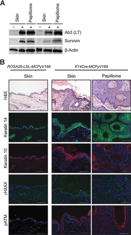 Figure 5. Interrogation of molecular pathways in K14Cre-MCPyV168 skin and papillomas. A, immunoblot analysis of whole tissue lysates isolated from the skin of two independent ROSA26-LSL-MCPyV168 mice and autologous skin samples and papillomas of two independent K14Cre-MCPyV168 mice using antibodies to MCPyV LT, survivin, and β-actin as a loading control. B, representative images of H&E and immunofluorescence staining on tissue sections from age and location-matched ROSA26-LSL-MCPyV168 skin (left) and either non-papilloma associated skin (middle) or a papilloma (right) harvested from a K14Cre-MCPyV168 mouse. Immunofluorescence analysis for keratin 14 (AF488; green), keratin 10 (AF594; red), and γ-H2AX staining (AF488; green) was performed on immediately adjacent tissue sections, whereas pS1981-ATM staining (pATM; AF488; pseudocolored red) was performed on a nonadjacent tissue section. DAPI was used to counterstain cellular nuclei. +, mice positive for Cre recombinase; −, Cre-negative mice. Scale bars, 100 μm.