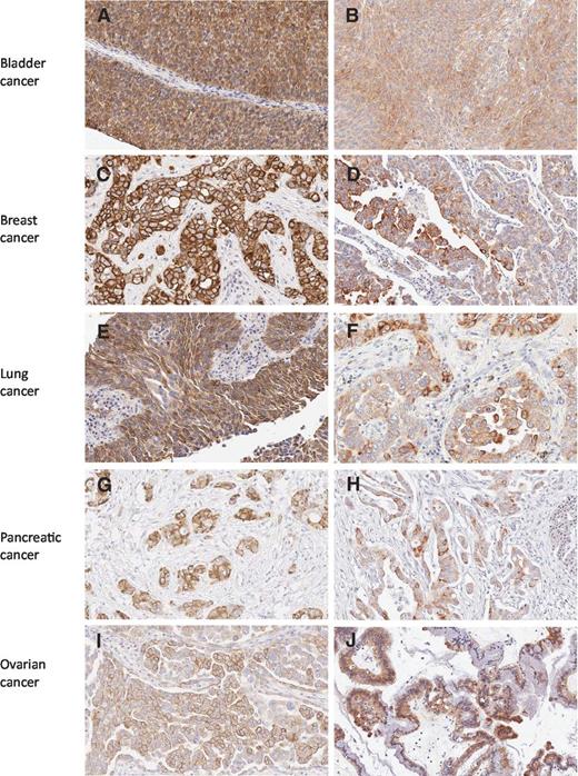 Figure 2. Nectin-4 expression in human cancer patient specimens. Representative FFPE tissue sections analyzed by IHC for nectin-4 are shown. A, transitional bladder carcinoma with strong expression. B, transitional bladder cancer with moderate expression. C, breast carcinoma with strong expression. D, breast carcinoma with moderate expression. E, lung squamous carcinoma. F, lung adenocarcinoma. G, pancreatic adenocarcinoma with strong expression. H, pancreatic adenocarcinoma with moderate expression. I, ovarian serous carcinoma. J, ovarian mucinous carcinoma.