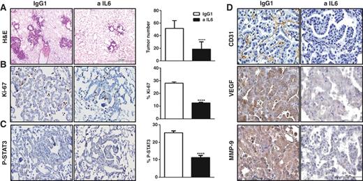 Figure 2. Anti-IL6 treatment reduces lung tumor burden, tumor cell proliferation, tumor angiogenesis, and STAT3 activation. A, histopathologic appearance of lung and lung surface tumor number in CC-LR mice at the age of 14 weeks after IgG1 (n = 8) or anti-IL6 treatment (n = 12; ×4; scale bar, 2 mm). B and C, representative photomicrographs and quantitative analysis of positive tumor cells for Ki-67, and P-STAT3 in lungs of CC-LR mice at the age of 14 weeks after IgG1 (n = 4) or IL6 (n = 5) blockade (×20; scale bar, 100 μm; data represent means ± SEM; ****, P < 0.001). D, representative photomicrographs of lung tumors stained for CD31, VEGF, and MMP-9 in CC-LR mice at the age of 14 weeks after IgG1 (n = 4) or IL6 (n = 5) blockade (×40; scale bar, 100 μm).