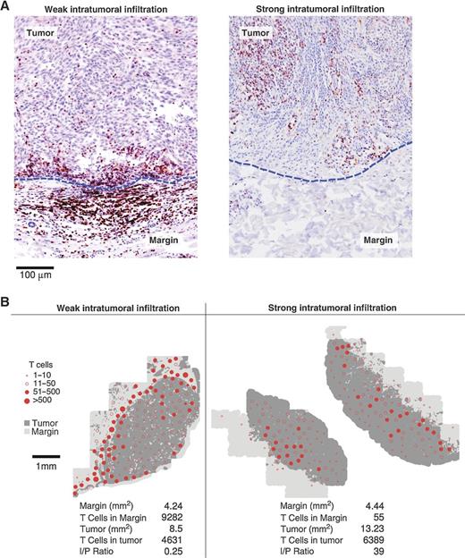 Figure 1. Mapping out T-cell landscapes near primary tumors. A, typical example (×20) of CD3+ T-cell distribution in the primary tumor with weak (left) and strong intratumoral T-cell infiltration (right). B, tissue classification and T-cell localization in two of the analyzed slides. The I/P ratio is the result of (intratumoral T cells/mm2)/(peritumoral T cells/mm2) and therefore is a ratio of T-cell densities rather than T-cell counts. For illustrative purposes, individual T-cell positions less than 150 μm apart were clustered.