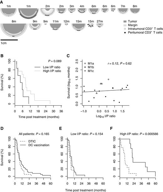 Figure 4. Strong intratumoral T-cell infiltration is associated with a larger difference between DC vaccination and chemotherapy in a matched cohort. A, relative tumor size, size of peritumoral area, and CD3+ count of all patients in the chemotherapy cohort. Overall survival is shown above each tumor in months. Each large bullet point represents 1,000 T cells within the tumor (white) or in the peritumoral area (black). B, survival of patients treated with chemotherapy with low (<1, n = 6) and high (>1, n = 13) I/P ratios (P = 0.089). C, correlation between I/P ratio and survival in months are shown on a log–log scale for all patients. D, analysis of a combined cohort in which each of the 19 chemotherapy patients was matched to two patients from the DC vaccination cohorts (giving n = 57) that were matched on LDH and M1c substage. E, longer survival upon immunotherapy is not apparent in patients with low I/P ratio (<1; n = 36). F, yet, there is a significant difference for patients with high I/P ratio (>1; n = 21).