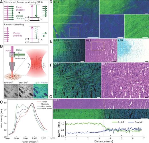 Figure 1. Label-free chemical imaging of human brain with SRS microscopy. A, energy diagrams of SRS and spontaneous Raman scattering. In spontaneous Raman scattering, a small amount of photons are shifted in energy from the laser frequency due to their interaction with the vibrational levels of molecules in the sample. The energy shift is defined as Raman shift, which is often reported in wave numbers (cm−1). Note that spontaneous Raman scattering is typically very weak. SRS occurs when the sample is excited by synchronized pump and Stokes beams of ultrafast lasers. The frequency difference of the two laser beams defines the Raman shift used for imaging. SRS signals are much stronger than spontaneous Raman scattering due to the stimulated emission process. B, schematic representation of SRS microscopy (top), and representative two-color SRS imaging of fresh brain tissue at 2,940 and 2,854 cm−1 (below). C, SRS spectra of brain tumor, white matter, gray matter, and necrotic tissue show distinct spectral features. D, SRS imaging of a fresh human brain tissue sample at the white matter and gray matter junction (green, lipid; blue, protein). White matter is featured by strong lipid signals mainly from the myelin sheath. Gray matter contains lower lipid composition, shown in dark blue. Scale bar, 100 μm. E, SRS imaging (left) of frozen normal human brain tissue sections from an autopsy case (case A1). SRS imaging could rapidly and clearly identify white and gray matter based on the lipid/protein contrast. In contrast, H&E staining images (middle) did not provide a clear distinction between white and gray matter. White matter was confirmed by LFB staining (right). F, zoom-in images in E show very fine structures of single myelin fibers at the transition area from white matter to gray matter. G, a large-scale image of white/gray matter (∼7 mm in length) and the intensity profile (sum along the vertical direction) shows that lipid content in the white matter is higher than that of the gray matter by approximately 2-fold. Scale bars, 100 μm (D and F); 500 μm (E and G).