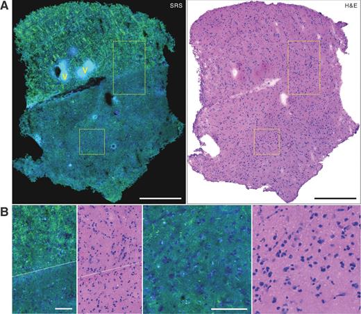Figure 2. Paired SRS and H&E imaging of a frozen sectioned whole specimen with cancer cell infiltration. A, the upper part of the specimen is basically white matter as shown by the strong lipid signals and the condensed myelin fibers, and the bottom part is gray matter with lower lipid signals. Red blood cells are shown in cyan color (V). B, zoom-in images display clear white/gray matter margin (left) and single-cell nuclei morphology, showing correlation between SRS and H&E (right). The presence of infiltrative cancer cells is confirmed by H&E-stained image. Images are from frozen specimen B2 of case 15 (anaplastic oligodendroglioma, grade III). Scale bars, 500 μm (A); 100 μm (B).
