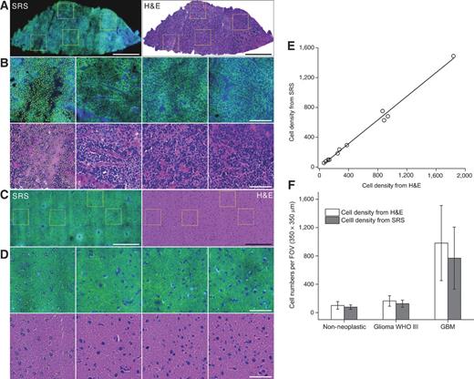 Figure 3. Quantification of cellularity with paired SRS and H&E imaging of frozen sectioned brain tissue. A, SRS (left) and H&E-stained (right) images of a whole specimen from a GBM case show hypercellularity. B, four zoom-in images in A demonstrate that the round shape of the cell nuclei can be clearly visualized. C, SRS (left) and H&E-stained (right) images of a non-neoplastic tissue section show very low cell density (epilepsy). D, zoom-in images in C show clear single-cell nuclei and correlation between SRS and H&E images. Yellow dots in the zoom-in images demonstrate the cell counting procedure. Images in A and B are from frozen specimen #3 of case 22 (GBM) and images in C and D are from frozen specimen A1 of case 42 (epilepsy). Scale bars, 500 μm (A, C); 50 μm (B, D). E, linear correlation plot of cell counting from SRS and H&E images (correlation factor R2 = 0.99). F, cell density tracing for non-neoplastic, glioma grade III, and GBM specimens. Data for non-neoplastic tissue include 41 (FOV) from the epilepsy case (case 42) and 69 FOV from the autopsy normal case A1. Data for glioma grade III include 15 FOV from case 39 and 27 FOV from case 15. Data for GBM include 29 FOV from case 22 and 6 FOV from case 9.