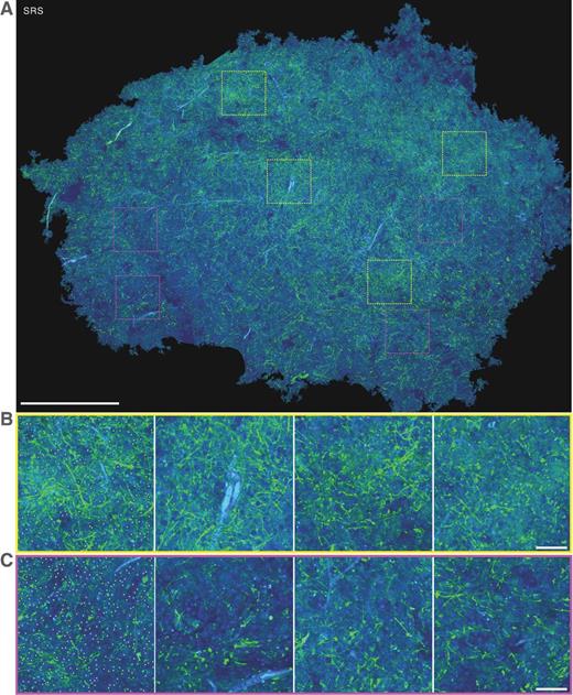 Figure 4. SRS imaging of fresh human brain tumor tissue. A, SRS image of the whole fresh specimen (∼1 mm in thickness). B and C, four zoom-in images in A (yellow squares) show lower cell density, whereas the other four zoom-in images in A (magenta squares) show higher cell density (C), demonstrating tumor heterogeneity. Blood vessels with red blood cells are shown in cyan color. Single myelin fibers were visualized on the basis of the strong lipid contrast with high sensitivity. Images are from fresh specimen BL5E-1 of case 44 (oligodendroglioma grade II). Scale bars, 1 mm (A); 100 μm (B, C).