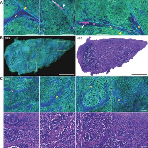 Figure 5. SRS and H&E–stained imaging of blood vessels to characterize vascular proliferation in GBM. A, SRS imaging of fresh brain tumor tissue shows blood vessels (blue) with red blood cells (magenta). Cell nuclei of the endothelial cells of the blood vessels are clearly visualized on the basis of the protein contrast. B, paired SRS and H&E imaging of the whole tissue section show vascular proliferation in a GBM case. C, zoom-in images of B show that the blood vessels can be visualized with high specificity by SRS imaging (V). Images in A are from fresh specimen 03 #2 of case 46 (GBM), and images in B and C are from frozen specimen #2, case 22 (GBM). Scale bars, 100 μm (A, C); 500 μm (B).
