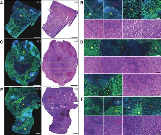 Figure 6. Paired SRS and H&E–stained imaging of tissue from a GBM case shows extensive necrosis. A, a specimen with extensive necrosis (bottom, N) and a smaller area of viable tumor (top, T). B, a specimen with a small viable tumor core surrounded by necrotic tissue. C, a specimen with mixed distribution of viable tumor and necrosis. Zoom-in images in A, C, and E are shown in B, D, and F, respectively. Necrosis and viable tumor show very different morphologic features and the boundary between these regions is resolved with subcellular resolution. All images were from case 9 (GBM). Scale bars, 500 μm (A, C, E); 100 μm (B, D, F).
