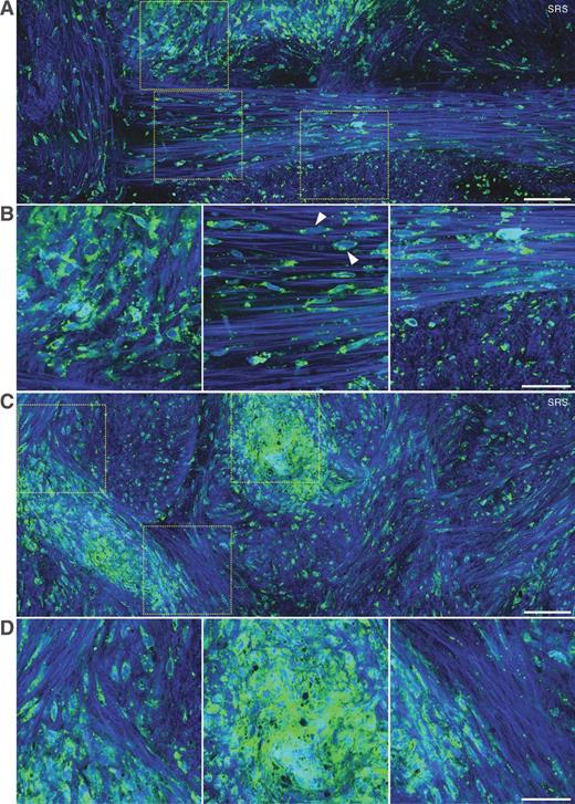 Figure 7. SRS imaging of massive collagen deposition in a fresh specimen from a recurrent/residual GBM surgical case. A and C, two representative large fields of view of the fresh human brain tumor tissue show the codistribution of collagen and tumor cells. Both isolated single cells and cell clusters are observed. Zoom-in images of A and C are shown in B and D, respectively. A lot of lipid droplets were found in the condensed cells region. Images are from fresh specimens of case 52. Scale bars, 100 μm (A, C); 50 μm (B, D).
