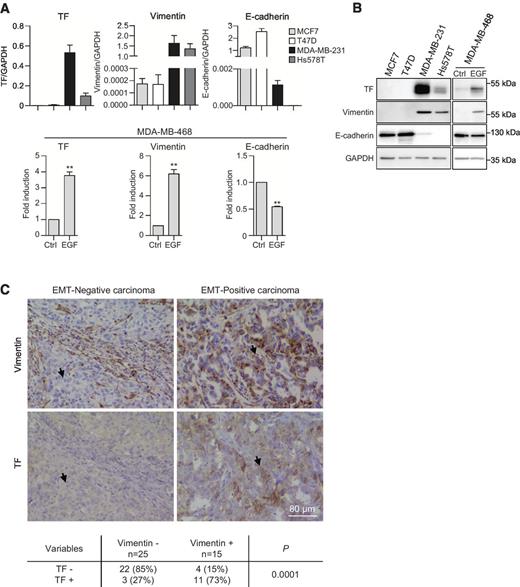 Figure 1. TF expression and EMT status in different cell systems. A, qRT-PCR analyses of TF, vimentin and E-cadherin in EMT− and EMT+ cell lines and in MDA-MB-468 cells not treated (Ctrl) or treated with EGF. **, P < 0.01. B, Western blotting analyses of TF, vimentin, and E-cadherin, and GAPDH protein as loading control. C, illustrative microscopy images of vimentin and TF staining on serial sections in TNBCs. An EMT− (left, no vimentin in tumor cells) and an EMT+ (right, presence of vimentin in tumor cells) representative carcinoma are shown. Arrows, double negative or double positive tumor areas. Results of the statistical Fisher test analysis are presented.