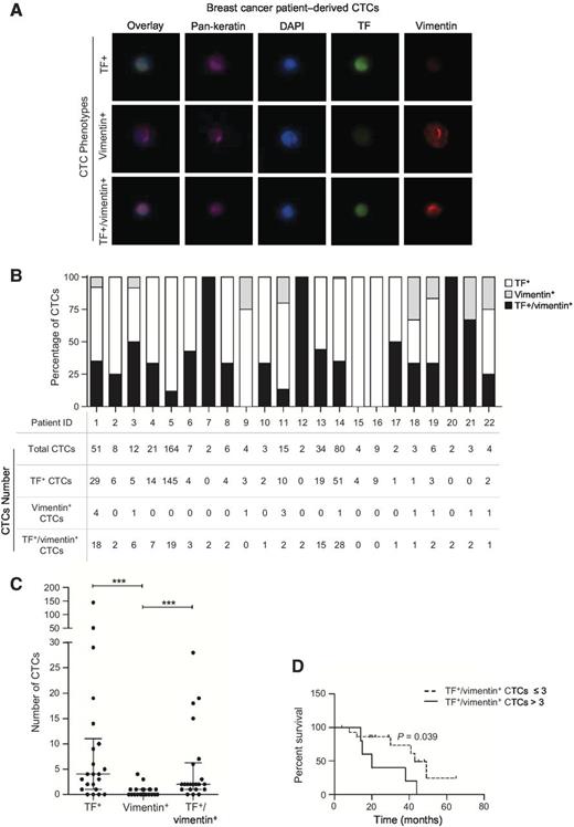 Figure 7. TF and vimentin expression in CTCs isolated from MBC patients. A, representative images of the triple immunostaining performed on ScreenCell filters showing the CTC phenotypes found in MBC patients (pan-keratin, pink; TF, green; vimentin, red; DAPI, blue). B, quantitation of CTC phenotypes in each patient. C, graph plot of CTC numbers found in MBC patients as a function of their phenotype (CTCs expressing only TF, only vimentin, or both). ***, P < 0.001. D, association between TF+/vimentin+ CTCs and overall survival of MBC patients (cut-off point at 3 TF+/vimentin+ CTCs, Kaplan–Meier method with log-rank test).