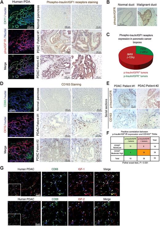 Figure 3. Insulin and IGF1 receptors are activated on cancer cells in biopsies from patients with PDAC, and this correlates with increased numbers of TAMs. A, Left, confocal microscopy images of frozen human PDAC tissues immunofluorescently costained for the tumor epithelial marker CK11 (green), phospho-insulin/IGF1 receptors (red), and nuclei (blue). Scale bar, 100 μm. Right, immunohistochemical staining of phospho-insulin/IGF1 receptors in normal human pancreas and biopsies from patients with PDAC. Scale bars, 100 μm and 50 μm. B, Images of normal and malignant human pancreatic ducts immunohistochemically stained for phospho-insulin/IGF1 receptors. Scale bar, 50 μm. C, Pie diagram representing the percentage of phospho-insulin/IGF1 receptor–positive (red) and negative (green) tumors assessed in tissue microarrays containing biopsies from 53 consented PDAC patients. D, Left, confocal microscopy images of frozen human PDAC tissues immunofluorescently costained for CD68 (green), CK19 (red), and nuclei (blue). Scale bar, 100 μm. Right, immunohistochemical staining of CD163 in normal human pancreas and biopsies from patients with PDAC. Scale bars, 100 μm and 50 μm. E, Serial sections of biopsies from human PDAC samples immunohistochemically stained for phospho-insulin/IGF1 receptors and CD163. Scale bar, 50 μm. F, Contingency table and results from statistical analysis showing a strong evidence of positive correlation between phospho-insulin/IGF1R expression in tumors and increased CD163+ macrophage infiltration. Relative risk = 4.92 [95% confidence interval (CI), 1.82–13.34], P = 0.001 using Fisher exact test. G, Immunofluorescent images of human PDAC tissues stained for CD68 (green), IGF1 or IGF2 (red) and nuclei (blue). White stars, CD68+ macrophages that express IGF1 or IGF2. Scale bar, 50 μm.