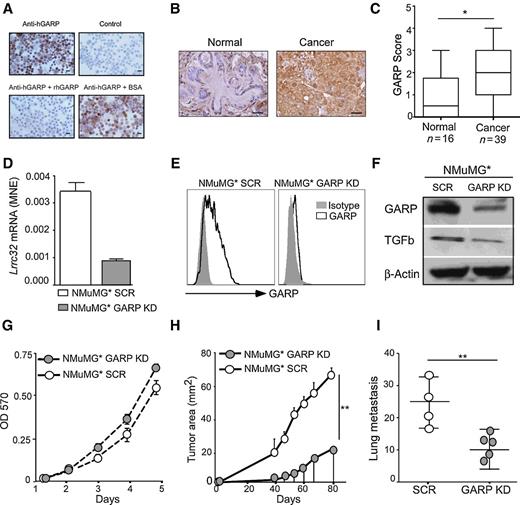 Figure 1. GARP expression in human breast cancer and its oncogenic roles in murine mammary gland epithelial cells. A, IHC validation of the hGARP antibody using murine 4T1 cells expressing hGARP. Top, staining of 4T1 cells expressing hGARP with anti-hGARP or control antibody; bottom, hGARP antibody was preadsorbed with 10 μg of recombinant hGARP (rhGARP) or 10 μg of BSA for 30 minutes at room temperature prior to the application on the slides. Scale bar, 40 μm. B, Representative images of GARP IHC (brown) of breast cancer with their matched normal breast tissues. Each patient specimen in these TMAs was represented in two cores on the slide and each core measured 1 mm in diameter. Scale bar, 50 μm. C, Expression intensity of GARP-positive cells in breast cancer specimens and normal breast tissues. D, shRNA knockdown of GARP mRNA in NMuMG* cells. Cells treated with scrambled shRNA (SCR) were used as control. Real-time RT-PCR was performed to quantify mRNA of Lrrc32, using β-actin as a control. MNE, mean normalized expression. E, Flow cytometric analysis of cell surface GARP expression on GARP KD and SCR NMuMG* cells. F, Immunoblot of GARP and TGFβ level in GARP KD and SCR NMuMG* whole-cell lysates. G, In vitro cell proliferation assay for GARP KD and SCR NMuMG* cells by MTT assay. OD, optical density. H, NMuMG* SCR and NMuMG*-GARP KD cells were injected into NOD-Rag-1−/− mice, followed by weekly monitoring of the tumor growth kinetics. I, 120 days after tumor injection, lungs gross metastatic nodules were counted visually on the surface of the organ. **, P < 0.01. Statistical analysis was determined by two-way ANOVA or two-tailed t test, where appropriate. Data are representative of at least two independent experiments.