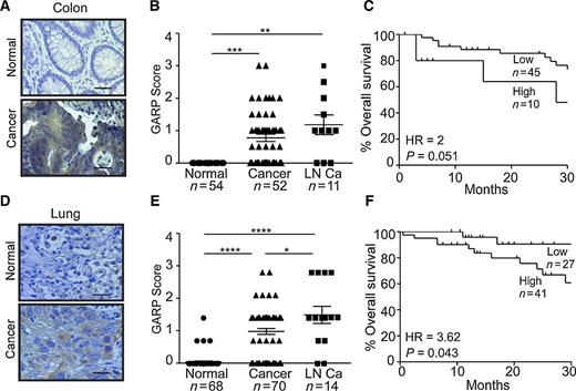 Figure 6. GARP upregulation in human colon and lung cancer correlates with poor prognosis. A, Representative images of GARP IHC (brown) of colon cancers with their respective patient-matched normal tissue. Each patient specimen in these TMAs was represented in two cores on the slide and each core measured 1 mm in diameter. Scale bar, 20 μm. B, Expression intensity of GARP-positive cells in colon cancer. C, Correlation between GARP expression and overall survival of colon cancer. D, Representative images of GARP IHC (brown) of lung cancers with their respective patient-matched normal tissue. Each patient specimen in these TMAs was represented in two cores on the slide and each core measured 1 mm in diameter. Scale bar, 20 μm. E, Expression intensity of GARP-positive cells in lung cancer and normal lungs. F, Correlation between GARP expression and overall survival of lung cancer. *, P < 0.05; **, P < 0.01; ***, P < 0.001; ****, P < 0.0001. Statistical significance was analyzed by two-tailed Student t test or Kaplan–Meier analysis; the numbers of samples (n) are indicated.