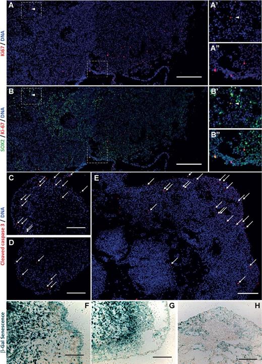 Figure 5. Spatial and phenotypic cellular heterogeneity in organoids. A and B, immunofluorescence mosaic imaging of Ki-67 and SOX2 protein in IN528 organoids; scale bars, 400 μm. Insets (A'–B'') are magnified regions of the mosaic span as indicated by dashed boxes. C–E, immunofluorescence imaging specific to cleaved caspase 3 protein in IN528 (C and D) and 387 (E) organoids. White arrows, positive cells; scale bars, 200 μm. F–H, light micrographs of X-Gal detection of senesence-associated β-galactosidase in IN528 (F, G) and 387 (H) organoids. Scale bars, 100 μm (F), 200 μm (G), and 400 μm (H).