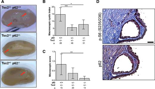 Figure 1. p62 promotes kidney tumorigenesis in Tsc2+/− mice. A, Representative kidneys of 10-month Tsc2+/− p62+/+, Tsc2+/− p62+/−, and Tsc2+/− p62−/− littermates. Arrows, macroscopic cysts. B, The macroscopic cystic index was assessed for each kidney using an established method based on the number and size of the lesions. C, The microscopic score was determined by an established method for assessing cyst size and tumor filling from H&E sections. D, Phosphorylated S6 (S235/236) and p62 expression in cystadenoma lesions of Tsc2+/− mice. Scale bar, 50 μm. n, number of kidneys analyzed. Data presented as mean ± 95% CI with *, P < 0.05; ***, P < 0.001.