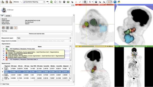 Figure 1. Result of loading postprocessing results stored in DICOM for subject 139 from the TCIA QIN-HEADNECK collection (3) using QuantitativeReporting extension of 3D Slicer, which uses dcmqi for DICOM data conversion. The interactive visualization includes multiplanar reformats of the original PET image data with overlay of segmented areas, 3-dimensional rendering (top right), coded terminology of the annotated regions (yellow tooltip rectangle), and a table of the image-based measurements over the segmented areas. All of these data components were restored from DICOM objects retrieved from TCIA.
