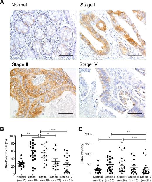 Figure 1. Evaluation of LGR5 expression in colon cancer patient specimens. A, IHC staining with an anti-LGR5 antibody was performed in normal colon and colon cancer specimens at different stages. Representative images are shown. Scale bar, 100 μm. B and C, Quantification of percentage of LGR5-positive cells (B) and LGR5 staining intensity (C) was performed. The values of individual samples are shown. Error bars, SEM of the values in each group. *, P < 0.05; **, P < 0.01; ***, P < 0.001.