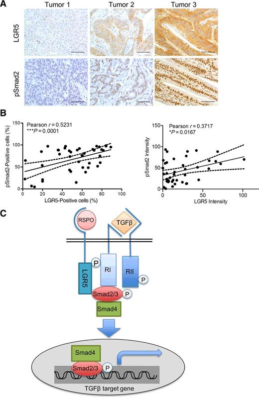 Figure 7. LGR5 expression positively correlates with TGFβ activity in colon cancer specimens. IHC staining of LGR5 and pSmad2 was performed in 49 colon cancer samples. A, Images of IHC staining of LGR5 and pSmad2 in three different colon tumors are shown. Scale bars, 100 μm. B, Quantification of percentage of LGR5- and pSmad2-positive cells (left) and their staining intensity (right) was performed. Correlation of expression of LGR5 and pSmad2 was determined using Pearson test (n = 49). Lines with 95% confidence bands in dashed lines are the result of linear regression analysis [left, Y = (38.29 ± 9.13) + (0.58 ± 0.16)X; right, Y = (37.27 ± 5.71) + (0.43 ± 0.172)X]. C, Proposed model of TGFβ signaling mediated by TGFβ/RII and RSPO/LGR5 collaboratively. Upon binding, TGFβ or RSPO, TGFβ RII, and LGR5 form complexes with TGFβ RI and activate it, leading to phosphorylation and activation of Smads downstream.