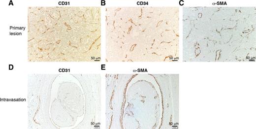 Figure 3. Immunostaining of vascular markers in human ASPS. A–C, Primary tumor. CD31-positive (A) and CD34-positive (B) endothelial cells and aSMA-positive (C) hemangiopericytes could be observed in the vascular network. D–E, Tumor intravasation. CD31-positive endothelial cells are positive in the blood vessel but only partially positive in the tumor encapsulation (D). In contrast, the intravascular tumor organoid is constitutively covered with aSMA-positive hemangiopericytes (E).
