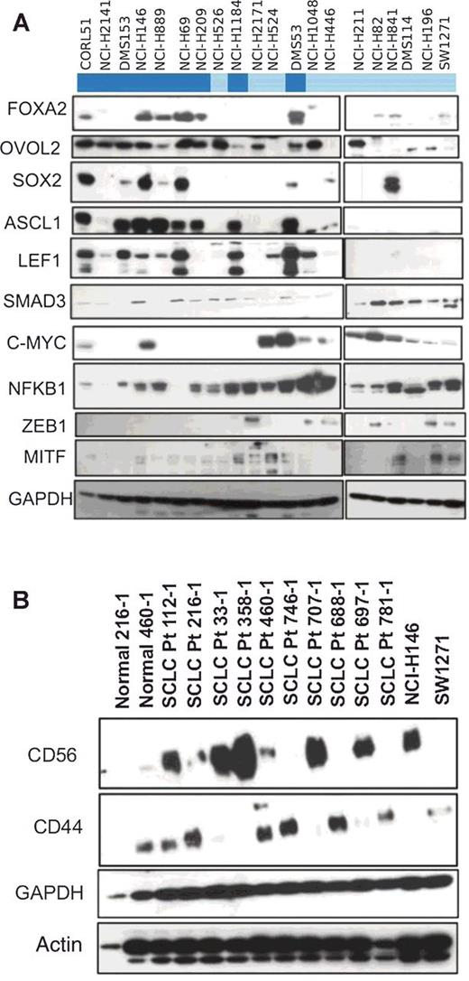 Figure 4. Experimental validation of TF network states in human SCLC. A, Five NE TFs (FOXA2, OVOL2, SOX2, ASCL1, and LEF1) and 5 ML TFs (SMAD3, MYC, NFKB1, ZEB1, MITF) validated by Western blot. The NE TFs show higher expression in the NE cell lines (dark blue, as in consensus clustering) than in the ML cell lines (light blue) and vice versa. Nevertheless, several cell lines showed similar levels of expression of both NE and ML TFs, including NCI-H146, NCI-H209, NCI-H1184, DMS53, NCI-H1048, and NCI-H446. Many of these cell lines, such as DMS53, also showed poor correlation with any attractor in Fig. 3 and Supplementary Fig. S8, and were near the center in Fig. 2C, suggesting a non-NE and non-ML phenotype. These cell lines are tentatively denoted as “hybrid” phenotypes. B, CD56 (a NE marker) and CD44 (a ML marker) were probed by Western blots in 10 SCLC patient samples. Most patients show expression of only one or the other; however, Pt112-1, Pt216-1, and Pt460-1 show double positive expression of both markers, suggesting the hybrid phenotype may be important in patients as well.