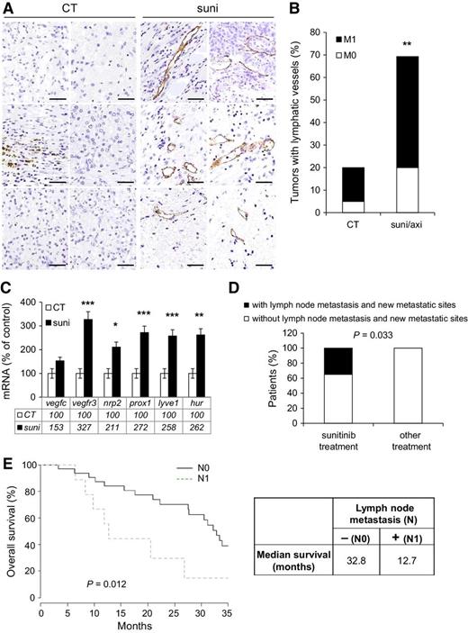 Figure 7. Sunitinib induced lymphangiogenesis and metastasis in lymph nodes of RCC patients. Tumors from untreated RCC patients and tumors from patients treated with sunitinib or axitinib in a neoadjuvant setting were compared (see Supplementary Table S1A). A, Lymphatic endothelial cells were detected by podoplanin (PDN) immunolabeling (brown). Scale bar, 25 μm. B, Quantification of the podoplanine (PDN)-positive vessels. C, The levels of indicated mRNA were determined by qPCR. D, RCC patients that progressed on treatment were analyzed for the presence of lymph node metastasis and new metastatic sites (two or more new sites). Patients were stratified for sunitinib or other antiangiogenic treatments (see Supplementary Table S1B). E, The Kaplan–Meier analysis of patients that had relapsed on sunitinib with noninvaded or de novo invaded lymph nodes.