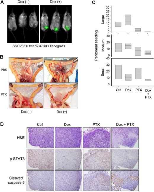 Figure 5. Targeting STAT3 suppresses peritoneal seeding and overcomes chemoresistance in vivo. A, Conditional knockdown of STAT3 concomitant with GFP expression in vivo. A doxycycline (Dox)-containing diet was administered to mice 2 weeks after the intraperitoneal injection, and GFP fluorescence was analyzed 1 week after the administration of the doxycycline-containing diet. B, The visible peritoneal seeding of the mesentery was substantially reduced in the STAT3 knockdown (Dox+) and/or Taxol treatment groups. C, Quantification of peritoneal metastases. Peritoneal tumor seedings: small (≤1 mm), large (>1 mm, ≤3 mm), and bulk (>3 mm). D, Hematoxylin and eosin (H&E) staining and IHC with antibodies against p-STAT3 and cleaved caspase-3.