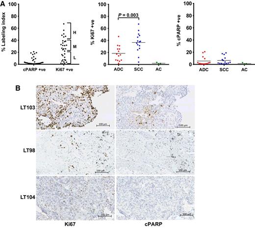 Figure 1. Intrinsic levels of proliferation and apoptosis in the tumors used for explants. A, Proliferation was assessed by quantitating Ki67 IHC staining and cell death by quantitating cPARP staining. Left, percentage of intrinsic proliferation and cell death in tumors. A single dot represents a single tumor sample. For the Ki67 staining, the samples were grouped into 1 of 3 groups: H, high (>40%); M, medium (20%–40%); L, low (0%–20%). The samples all had low intrinsic levels of cPARP staining. Middle and right, percentage of Ki67 and percentage of cPARP staining for tumors with adenocarcinoma (ADC), SCC, and atypical carcinoid (AC) histologies. The SCC samples had significantly higher levels of intrinsic proliferation compared with the adenocarcinoma samples whereas, the atypical carcinoid samples were indolent. Cell death levels were consistent across the histologies. B, Representative images of Ki67 (left) and cPARP (right) IHC staining of high (LT103; top), medium (LT98; middle), and low (LT104; bottom) proliferative tumors. IHC stains were counterstained with hematoxylin. LT103 (high proliferative tumor) and LT98 (medium proliferative tumor) represent SCC samples, whereas LT104 (low proliferative tumor) is an adenocarcinoma. Scale bars, 100 μm.