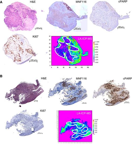 Figure 4. Pt ion distribution in cisplatin-sensitive and -resistant explants. A and B, Cisplatin-resistant explant (LT31; A) and cisplatin-sensitive explant (LT88; B). Both samples were treated with 10 μmol/L cisplatin. Serial sections of explants stained with H&E staining are shown in the top left, and IHC staining with antibodies for MNF116 (top middle), cPARP (top right), and Ki67 (bottom left) are also shown. LA-ICP-MS samplings to indicate the distribution of Pt ions within each explant are shown in the bottom right. The white lines indicate tumor areas as determined by H&E and MNF116 staining. Scale bars, 100 μm.