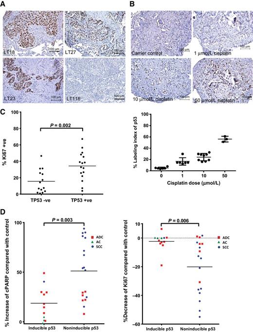 Figure 5. TP53 expression. A, IHC staining of explants treated with cisplatin demonstrating tumors with constitutively high levels of nuclear TP53 in tumor cells (LT18, LT27, and LT23) or low levels of TP53 (LT116). Scale bars, 100 μm. B, IHC staining and quantitation of nuclear p53 staining in a TP53WT explant sample demonstrating dose-dependent TP53 expression following cisplatin treatment. The graph shows the percentage of mean labeling index of TP53 ±SD following treatment of the tumor sample with increasing doses of cisplatin (P = 0.0001). Scale bars, 100 μm. C, Correlation of intrinsic proliferation index with TP53 IHC staining. The graph shows the percentage of Ki67 staining of tumors classified according to TP53 IHC staining. Each circle represents one sample. D, Induction of cell death, as assessed by cPARP staining (left graph), and reduction of proliferation (right graph), as assessed by Ki67 staining, upon 50 μmol/L cisplatin treatment of 30 NSCLC ex vivo explants stratified according to their ability to induce TP53 expression upon treatment with the drug. The data show that TP53-inducible tumors have a significantly reduced (P = 0.003) ability to undergo cell death in response to cisplatin compared with TP53-noninducible tumors. The majority of these tumors are of the SCC subtype.