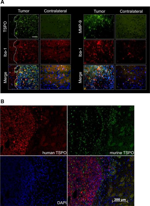 Figure 4. Role of GAMs for TSPO/MMP signal. A, Double immunohistochemistry of Iba-1 (red) with TSPO (green, left) and MMP-9 (green, right) showed Iba-1–expressing cells as source of TSPO and MMP-9. Scale bar, 50 μm. B, Comparison of human TSPO (red) and murine TSPO (green) identified tumor cells as major source of TSPO. Infiltrating murine cells also contributed to the TSPO signal. Scale bar, 200 μm.