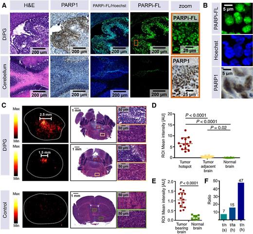Figure 3. Intratumoral accumulation of PARPi-FL and [18F]PARPi in mouse model of DIPG after intravenous injection. A, Juvenile brainstem tumor-bearing ntv-a/p53fl/fl mice were intravenously injected with 22.4 nmol PARPi-FL upon occurrence of symptoms of tumor growth (gait instability, weight loss, crouching, head swelling). Brains were processed for cryoconservation 2 hours p.i. of PARPi-FL. Cryosections were costained with Hoechst DNA stain and evaluated for presence of PARPi-FL (green fluorescence) using confocal microscopy. Adjacent sections were stained for PARP1 expression and H&E. Representative staining from n = 5. B, High magnification images from A showing nuclear localization of PARPi-FL, Hoechst, and PARP1. C, [18F]PARPi accumulation in DIPG and healthy control mice after intravenous injection. [18F]PARPi (150–170 μCi) was injected in juvenile brainstem tumor-bearing ntv-a/p53fl/fl mice (n = 4) or healthy ntv-a/p53fl/fl control mice (n = 2). For autoradiography, animals were sacrificed 2 hours p.i., brains were extracted and flash-frozen, and 20 μm coronal cryosections were cut. Sections were exposed to a storage phosphor autoradiography plate overnight at −20°C and read the following day. Adjacent sections were submitted for H&E staining for morphological confirmation that activity hotspots represent tumor tissue. D, For signal quantification, ROIs were placed on activity hotspots, tumor-adjacent brain, and corresponding sections in healthy brains (n = 3–8 ROIs per specimen) and results were pooled. E, To evaluate the difference between tumor-bearing and nontumor-bearing brains, ROIs were placed over entire tumor-bearing cross-sections, independent of size and number of activity hotspots, and intensities were compared with nontumor-bearing brains. F, Calculation of signal ratios using mean values of ROI categories: t, tumor; n, normal brain; ta, tumor adjacent; h, hotspot; s, section. Statistical significance was determined using an unpaired Student t test, assuming equal SD of populations.