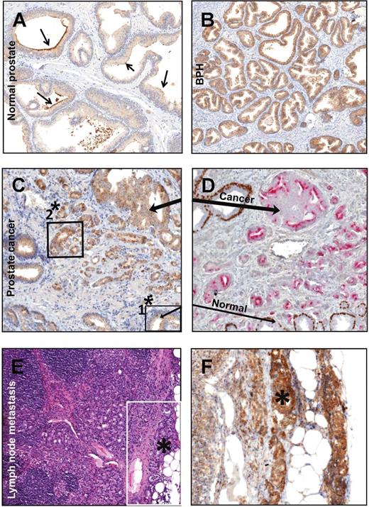 Figure 5. Cancer cells express pmCiC in primary tumors and at metastatic sites. Tissues in A, B, C, and F were stained with pmCiC-specific antibody. A, Normal prostatic tissue with prominent staining of epithelial cells surrounding the lumen, in particular their apical side (arrows). B, Benign prostatic hyperplasia with significant staining of luminal prostate epithelial cells (note stronger staining versus normal tissue; ×70 magnification used for both A and B). Tissue sections taken from the same cancerous gland stained for pmCiC (C) or combined p63 and Racemase/P504S (D). Brown staining in D indicates p63-positive nuclear and negative Racemase/P504S cytoplasmic staining characteristic for normal cells; cytoplasm-positive Racemase/P504S (pink) and nuclear negative p63 indicate cancer cells. Black arrows show respective areas of tissue to facilitate comparison between pmCiC versus p63-Racemase/P504S staining of cancerous and normal epithelial cells. (C and D, ×170 magnification). In addition, the areas representative for benign (1*) and cancer cells (2*) from C are enlarged and shown in Supplementary Fig. S4. E and F, Lymph node metastasis of prostatic cells. E, ×10 magnification. Lymph node with prostate cancer metastasis stained with hematoxylin and eosin (E) and the same tissue stained with pmCiC (F). The sequentially sectioned area of the same tissue is indicated with the white frame. Metastatic prostate cancer cells show increased expression of pmCiC (F, ×150 magnification). Black stars on both photos indicate the same area of the lymph node.