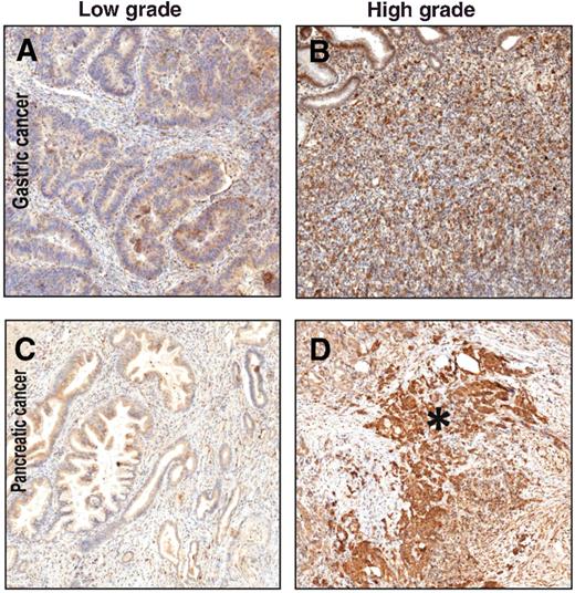 Figure 6. pmCiC is expressed in cancerous tissues of different origin. A–B, gastric cancer. Gastric adenocarcinoma, intestinal (glandular) type with irregular tubular structures is shown in A. pmCiC staining in this subtype is weak, focal, and patchy (predominantly apical), as compared with the gastric adenocarcinoma, diffuse type (B), with almost all signet-ring cells strongly stained with pmCiC. C–D, pancreatic cancer. Moderately differentiated pancreatic ductal adenocarcinoma cells (C) stain heterogeneously and weakly positive in the cytoplasm, whereas poorly differentiated pancreatic ductal adenocarcinomas (D; *) are strongly positive in a diffuse pattern. A–D, ×100 magnification.