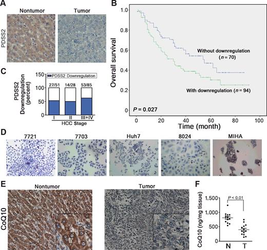 Figure 1. Downregulation of PDSS2 and CoQ10 was frequently detected in HCCs. A, Representative IHC images of PDSS2 staining in HCC tumor tissues and paired nontumor tissues (original magnification, ×200). B, Kaplan–Meier curve showing the overall survival rates in patients with HCC with or without PDSS2 downregulation. C, The percentage of PDSS2 downregulation in HCCs at different clinical stages determined by IHC. The numbers above the bars indicate the number of PDSS2 downregulated cases/total cases in each stage. D, PDSS2 expression was evaluated by IHC in HCC cell lines (SMMC7721, QGY7703, Huh7, and PLC8024) and an immortalized human liver cell line MIHA (original magnification, ×200). E, Representative IHC images of CoQ10 staining in HCC tumor and paired nontumor tissues. F, CoQ10 was measured in 13 pairs of HCC tumor tissues and paired nontumor tissues by ultra high-performance liquid chromatography tandem mass spectrometric analysis.