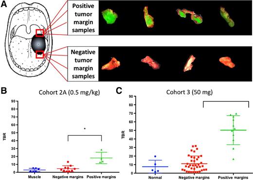 Determination of Tumor Margins with Surgical Specimen Mapping Using ...