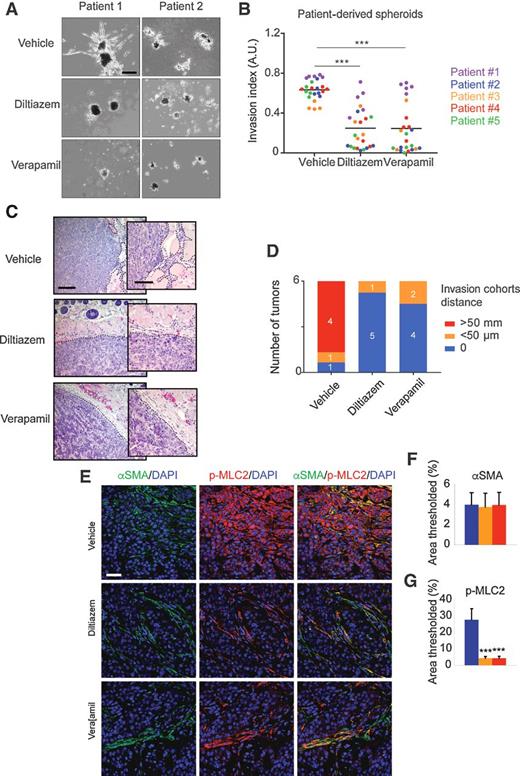 Figure 6. Diltiazem and verapamil prevent HNSCC tumor cell collective invasion. A, Representative pictures of human patient–derived HNSCC multicellular spheroid embedded in stiff matrices in the presence or absence of diltiazem (30 μmol/L) or verapamil (15 μmol/L) for 5 days. Scale bar, 200 μm. B, Quantification of HNSCC multicellular spheroid invasion shown in A (n = 5 for 5 individual patients; bars correspond to mean). A.U., arbitrary unit. C, Representative hematoxylin and eosin pictures of human patient–derived HNSCC tumors showing collective invasion in control, diltiazem, or verapamil-treated group mice. Scale bar, 200 μm. D, Quantification of tumors presenting invading cell cohorts shown in C (n = 6 tumors/group). E, Representative confocal images of αSMA, p-MLC2, and DAPI staining in PDX from control mice, verapamil or diltiazem-treated mice. Scale bar, 50 μm. F, Quantification of αSMA staining shown in E. G, Quantification of p-MLC2 staining shown in E. For all data, paired samples were compared by two-tailed Student t test, whereas one-way ANOVA and post hoc Tukey tests were used for group comparisons (NS, not significant; *, P < 0.05; **, P < 0.01; ***, P < 0.001).