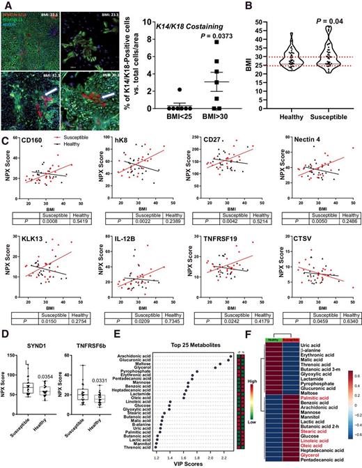 Figure 1. Identification of plasma factors from breast cancer–susceptible women. A, Primary mammary epithelial cultures from women who are BMI < 25 (nonobese) and BMI > 30 (obese). Keratin 8/18 and keratin 14 staining was evaluated by immunofluorescence. Arrows, K14/K18 double-positive cells. B, BMI distribution of samples from age, and racial and ethnic background–matched healthy and susceptible individuals (N = 40 matched pairs). Paired t test was used to compare BMI for matched healthy and susceptible individuals. C, Olink protein biomarker analysis of plasma samples from healthy (N = 29) and breast cancer–susceptible (N = 30) postmenopausal women. Protein biomarkers that correlate with BMI in susceptible individuals, but not healthy controls, are shown. A linear regression model was generated for BMI and NPX abundance scores of the plasma biomarkers. P values for the significance of nonzero slope of fitted lines are indicated for susceptible and healthy individuals. D, Protein biomarkers that are differentially abundant between susceptible versus healthy individuals were identified by t test. P values are indicated. E, Top 25 plasma metabolites that distinguish between healthy and susceptible individuals from samples in B were identified using biomarker analysis option in web-based MetaboAnalyst software. F, Heatmap of the whole metabolite profiling of plasma samples from susceptible and healthy individuals. Heatmap was generated using MetaboAnalyst software.