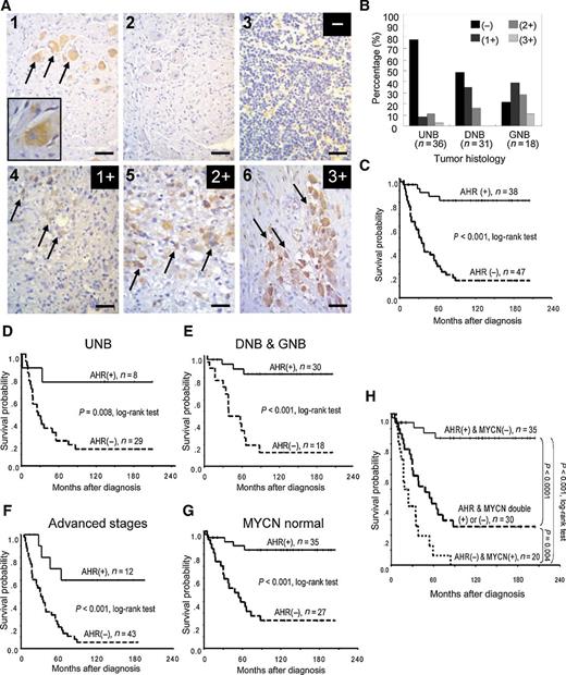 Figure 1. AHR expression predicts better clinical outcome for patients with neuroblastoma. A, IHC analysis of AHR expression in tumor tissues of patients with neuroblastoma. 1, AHR immunostaining of ganglioneuroma as positive control; 2, AHR immunostaining blocked by the specific peptide as negative control; 3, negative (−) AHR immuno-staining; 4, low (1+) AHR immunostaining; 5, medium (2+) AHR immunostaining; 6, high (3+) AHR immunostaining. Scale bar, 100 μm. B, Percentage distribution of AHR expression in undifferentiated neuroblastoma (UNB; n = 36), differentiating neuroblastoma (DNB; n = 31), and ganglioneuroblastoma (GNB; n = 18). C, Kaplan–Meier survival analysis according to the expression of AHR in 85 patients with neuroblastoma. D–G, Kaplan–Meier survival analysis according to the expression of AHR in patients with undifferentiated neuroblastoma (D), patients with differentiating neuroblastoma and ganglioneuroblastoma (E), patients with neuroblastoma with advanced stage disease (stage III and IV; F), and patients with neuroblastoma with normal MYCN copy number (without amplification; G). H, Kaplan–Meier survival analysis according to AHR expression and MYCN amplification in patients with neuroblastoma, with all P < 0.017 after Bonferroni adjustment for multiple pairwise comparisons.