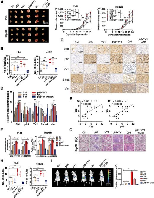 Figure 5. QKI expression is required for the YY1 complex to promote the metastasis and malignancy of HCC. A, Comparison of PLC-PRF-5 and Hep3B tumor growth in mice were measured starting 6 days after implantation. All of the groups were euthanized on day 24. B, Metastatic lung nodules were counted in each group. C, QKI, p65, YY1, E-cadherin, and vimentin expression levels in the tumor tissues of p65, YY1, p65+YY1, QKI, and p65+YY1+siQKI groups analyzed through IHC staining. D, IHC staining index of QKI, YY1, p65, E-cadherin, and vimentin in HCC tissues. E, Correlation analysis between p65 and QKI (P = 0.0012) and YY1 and QKI (P = 0.0048). F, qRT-PCR analysis of circ-0008150 and circ-0007821 levels in tumor tissues. G, Representative figures of hematoxylin and eosin staining on the serial sections of metastatic tumors in the lungs. H, Metastatic lung nodules were counted in each group. I, Representative images of in vitro BLI. Quantification of the signal intensity in each group. Quantified values are shown in total flux (photons/second). Data are presented as means ± SD. *, P < 0.05; **, P < 0.01.