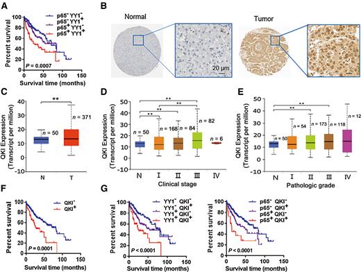 Figure 6. QKI is upregulated by YY1 complex, and it can promote the malignant progression of HCC. A, Survival analysis of TCGA samples for the relationship between survival time of HCC patients and p65 and YY1 expression levels. B, Representative QKI expression images of normal liver tissues and HCC samples. C, QKI expression level in HCC tumors and normal liver tissues based on TCGA dataset. D, Analysis on the QKI expression levels in TCGA LIHC samples based on an individual clinical stage. E, Analysis on the QKI expression levels in TCGA HCC samples based on an individual pathologic grade. F, Kaplan–Meier plots of the overall survival rate of patients with HCC with QKI low or high expression levels (P = 0.0001). G, Kaplan–Meier plots of the overall survival rate of patients with HCC with YY1/QKI low or high levels (left), and with p65/QKI low or high levels (right) (P < 0.0001). Data are presented as means ± SD. **, P < 0.01.