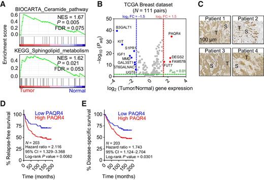 Figure 1. Expression of the sphingolipid metabolism–related gene PAQR4 is induced in tumors and negatively correlates with breast cancer patient survival. A, Functional analysis of DEGs comparing the transcriptomics of paired normal and tumor tissues from patients with breast cancer (n = 111) obtained from TCGA revealed an enrichment of genes in the ceramide signaling and sphingolipid pathway in tumor tissue. NES, normalized enrichment score; FDR, false discovery rate. B, Volcano plot showing deregulated sphingolipid-related genes when comparing transcriptomic profiles of paired normal and tumor tissue derived from patients with breast cancer (n = 111). The significant (Padjusted < 0.01) overexpressed genes (red circles) are represented as log2 (tumor/normal) gene expression >1.5 and downregulated (blue circles) as log2 (tumor/normal) gene expression <1.5-fold changes. C, Representative PAQR4 staining in patient with breast cancer tissue. S, stroma; T, tumor tissue. D and E, PAQR4 protein expression negatively correlates with patient survival (n = 203) as determined by Kaplan–Meier curves of RFS and DSS based on high (equal or more than 25% quartile, red curve) or low (25% quartile, blue curve) PAQR4 expression using log-rank test.