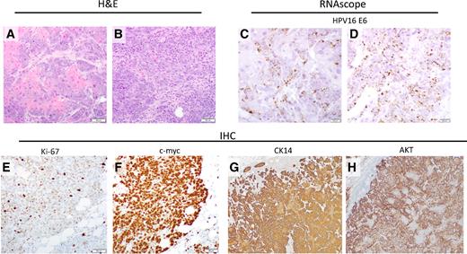 Figure 2. Representative images of HPV16+ spontaneous cervicovaginal tumor. Mice received transient CD3 cell depletion at day −3, −2, −1, 7, and 14. On day 0, C57BL/6 mice received 10 μg of each AMES-16 DNA plasmid (total injection volume 20 μg) as a submucosal injection in the vaginal tract, followed by electroporation. A and B, Representative H&E of tumor displaying well-differentiated (A) or poorly differentiated SCC (B). C and D, RNA ISH of HPV16 E6 for corresponding tumors shown in A and B. E, IHC of tumor proliferation marker Ki-67. F, IHC of c-myc. G, IHC of carcinoma marker CK14. H, IHC of AKT.
